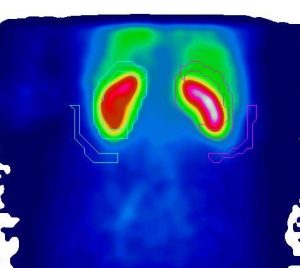 image d'un exemple de résultat de scintigraphie